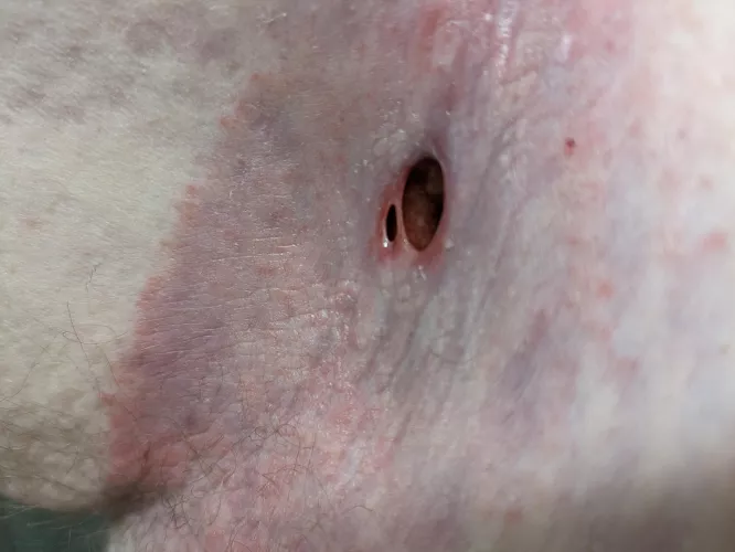 The swelling went down and a new hole formed