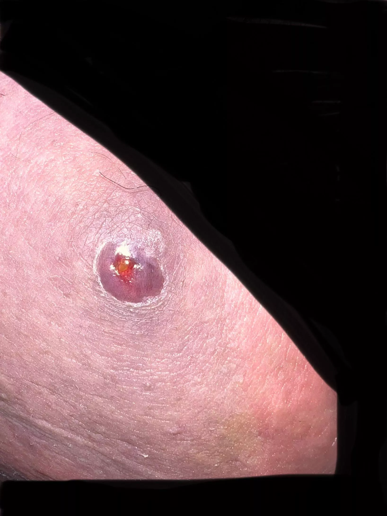 72 hours after popping