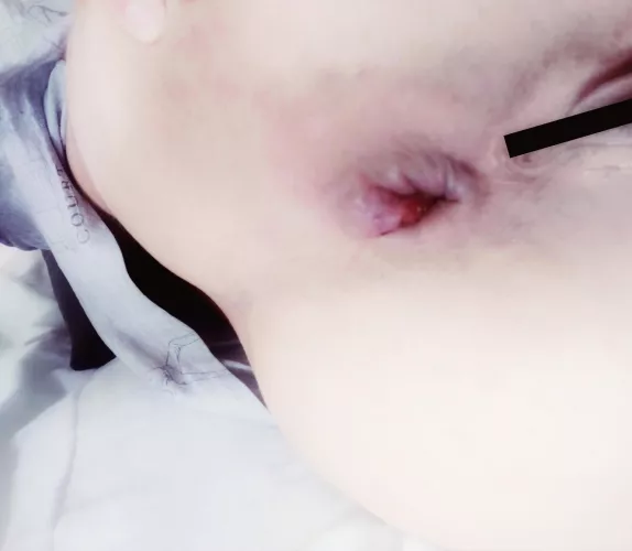My hole after some hard anal fisting 😳 (oc) f 28 