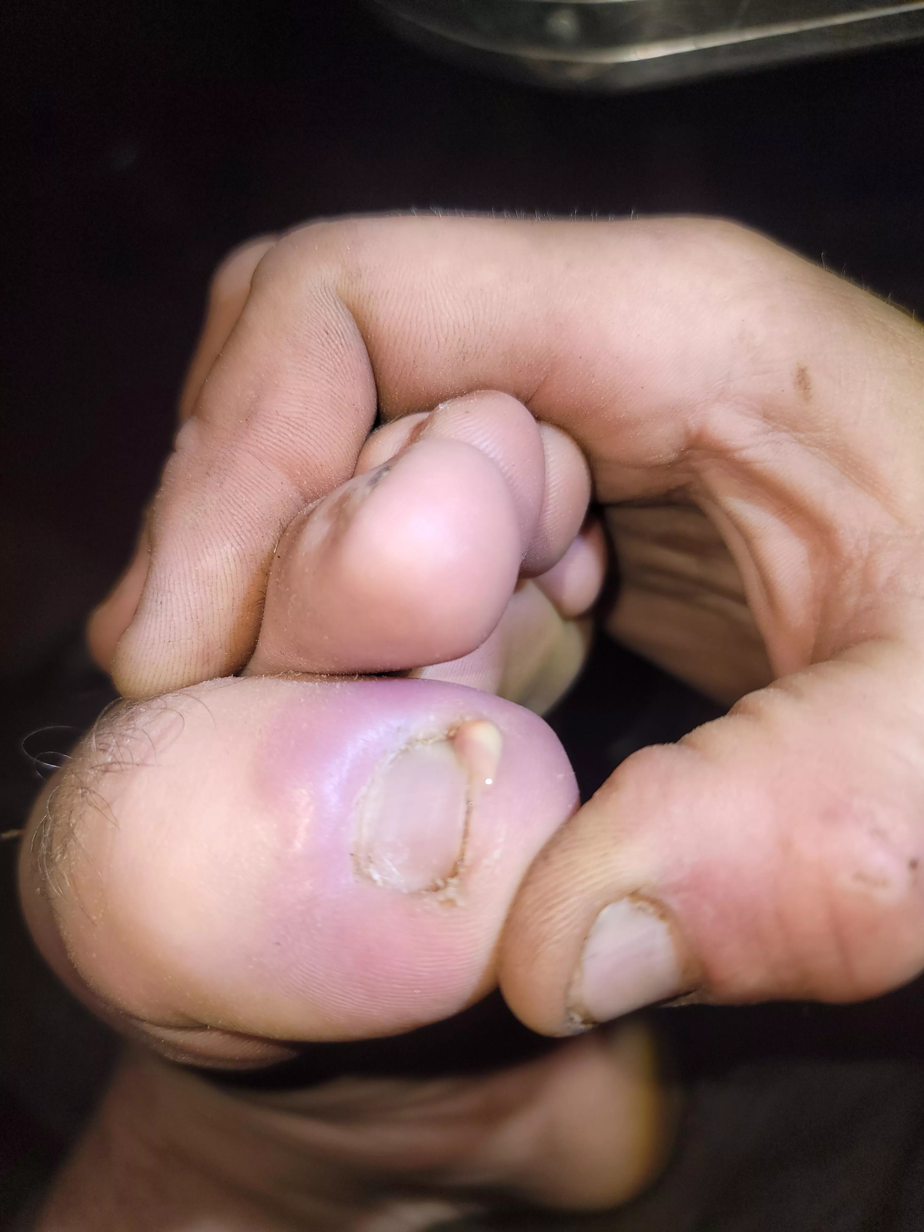 Got a staph infection under my toenail. Oh, the relief