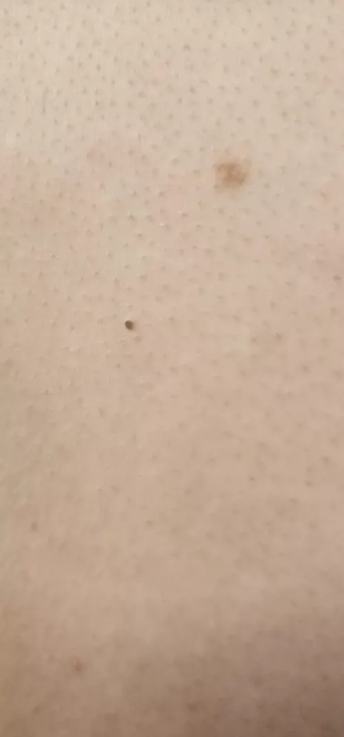 I so wish my roomie would let me pop this blackhead. You can tell it's a fat boy.