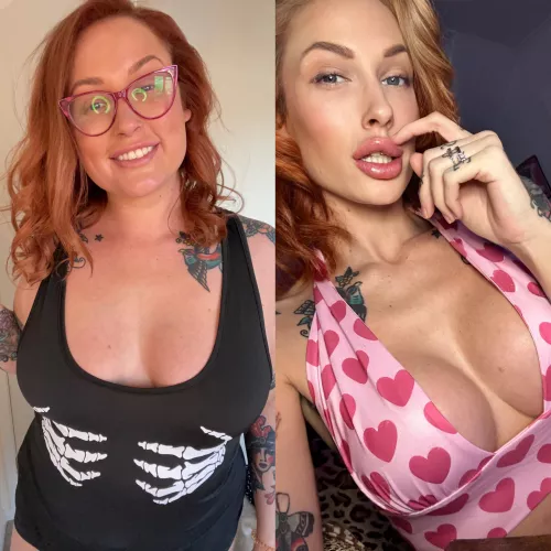 3 years between pictures, should I get more lip filler?