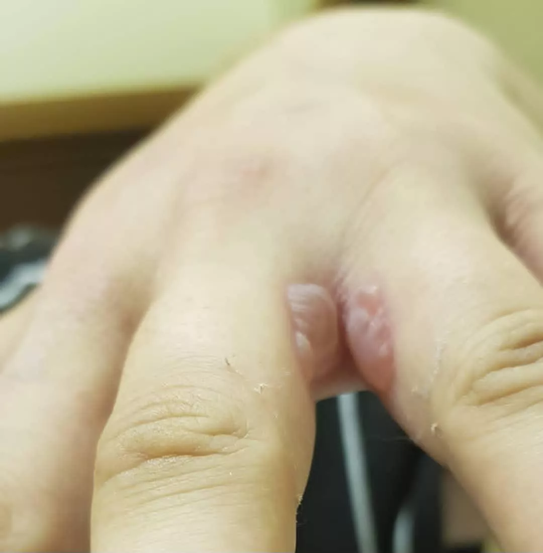 Forbidden blister pop, double the fun 🥴