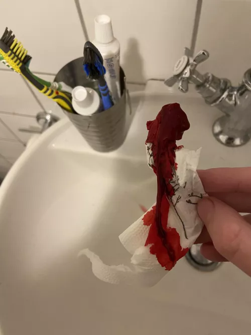 Pulled This out of my nose during a mighty nosebleed