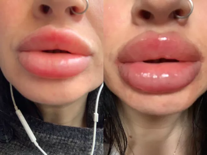 Just had a 2.5ml top up in two weeks I’ll have the same again