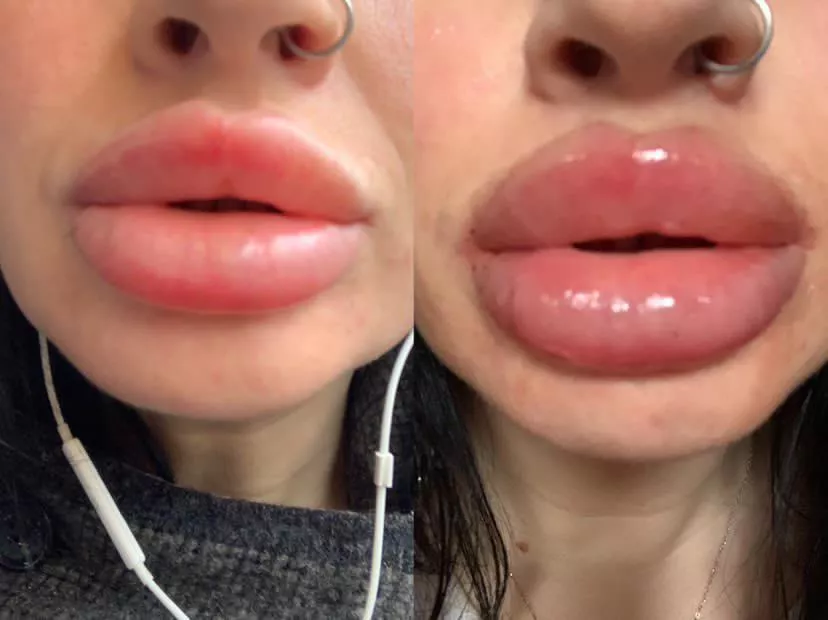 Just had a 2.5ml top up in two weeks I’ll have the same again