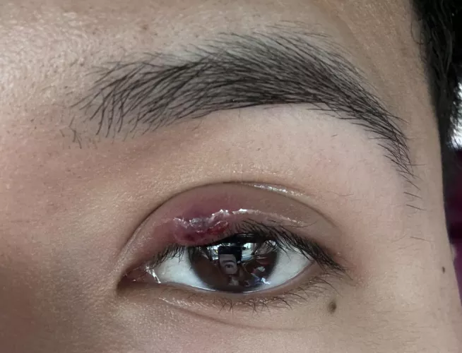 My stye/chalazion popped