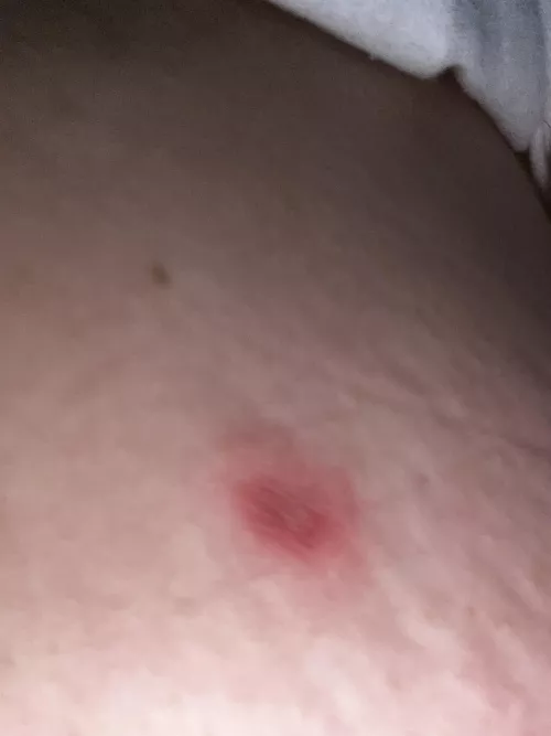 What kind of bite? Is this a wasp?