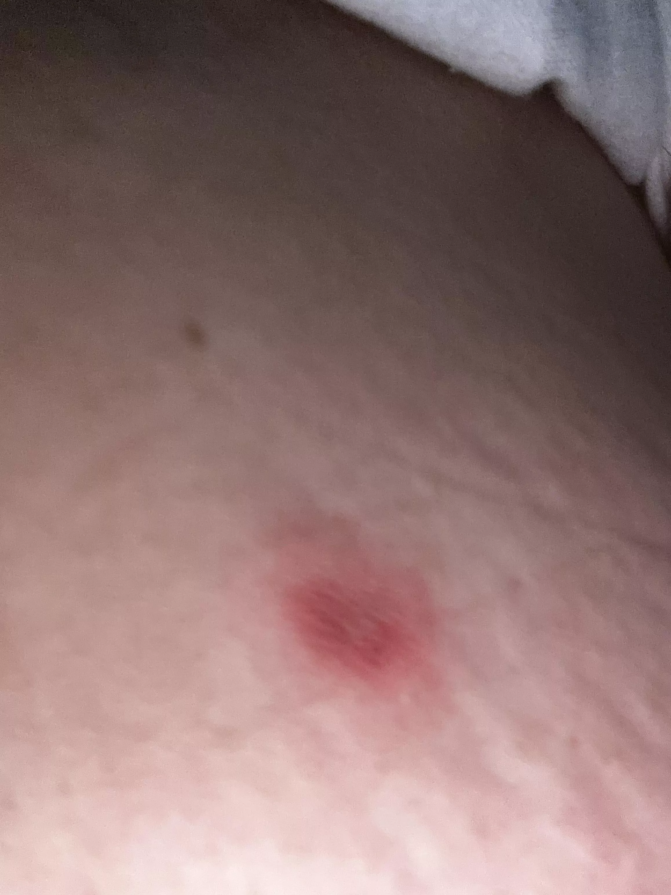 What kind of bite? Is this a wasp?