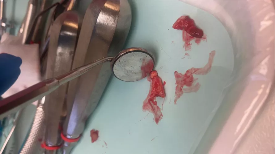 Had emergency oral surgery to remove an infection from an old root canal…