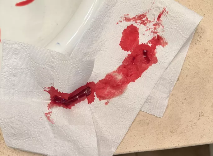 (NSFW tag for blood) First time post, sneezed a little too hard and massive blood clot (and bloody nose) followed