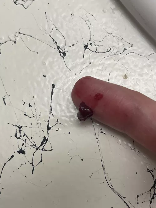 Super painful temple abscess