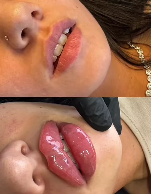 When you get filler, get Russian technique!