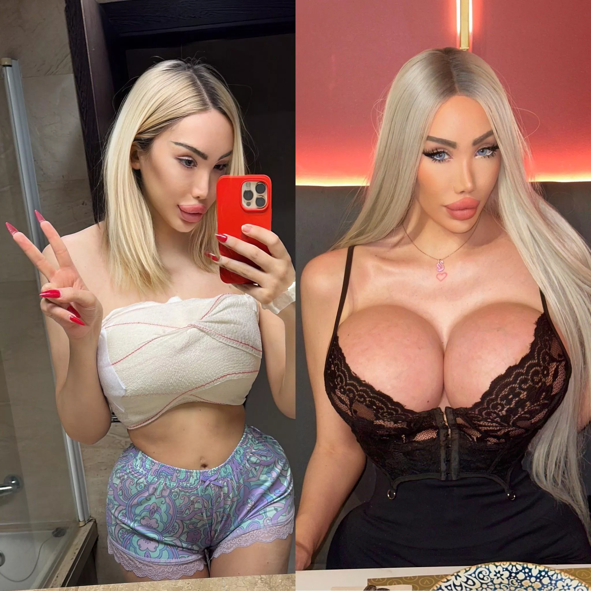 One year ago after having to replace my expanders and going back to 1100cc. I’m now bigger than ever with my 2500ccs. I wanted an implant with more projection and I got them 