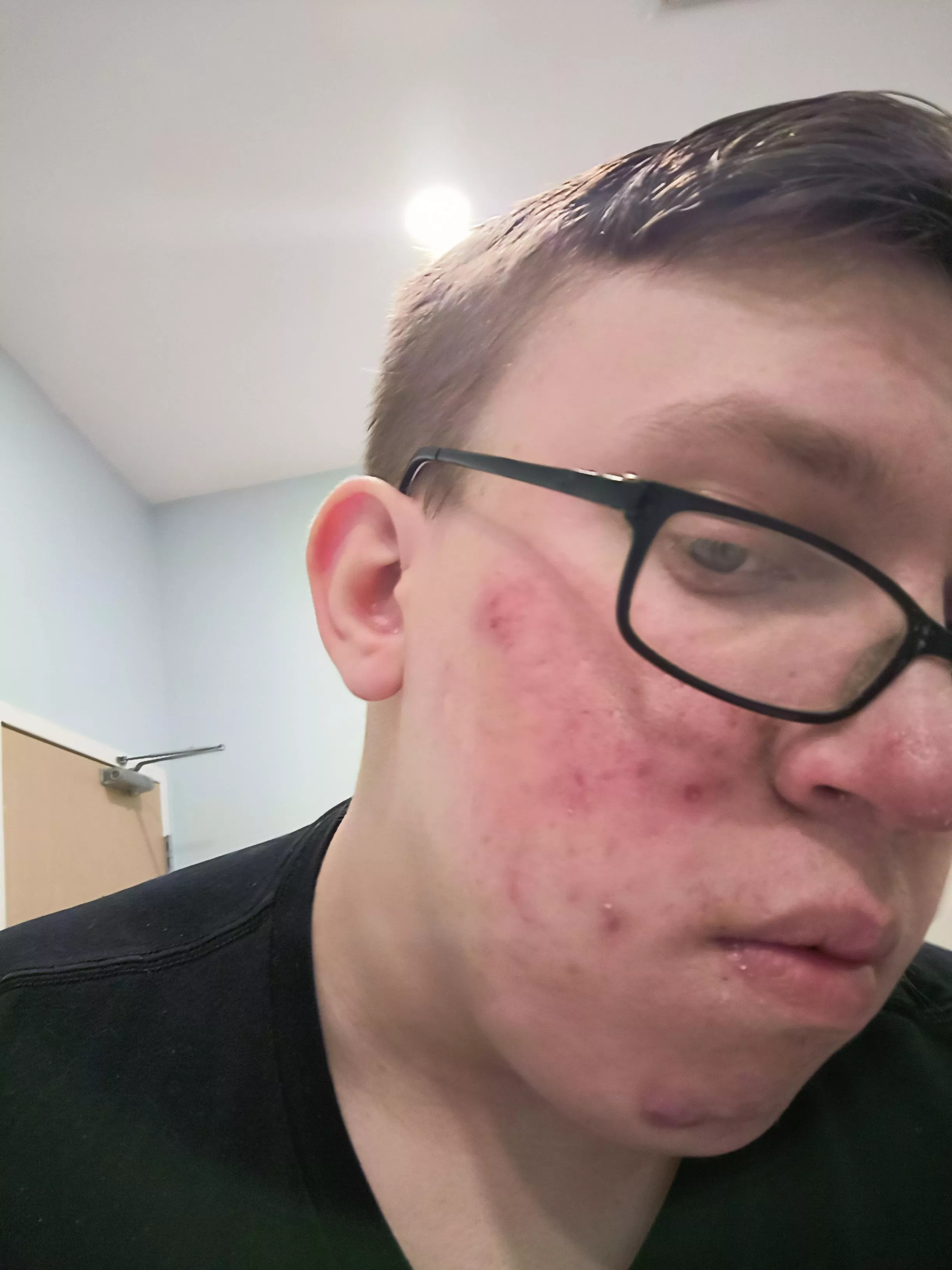 One month progress. Still using cervae, face washing twice a day and doxycycline. Will be having follow-up appointment to address redness. 