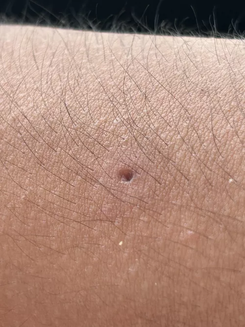 Update: juicy arm cyst