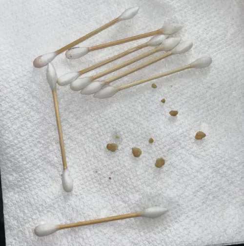 big tonsil stone haul 