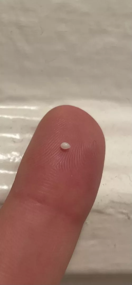 Little pearl emerged from a spot on my leg where I had a small cyst years ago