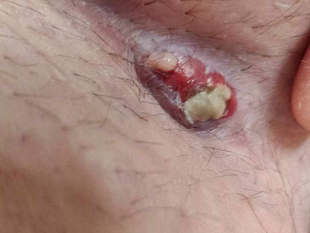 10th hour update, still to painful to pop 💀