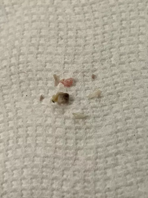 The grody results of what I thought was a regular pimple on my inner thigh from chafing! Wish I'd thought to record the very bloody cyst pop 🍾