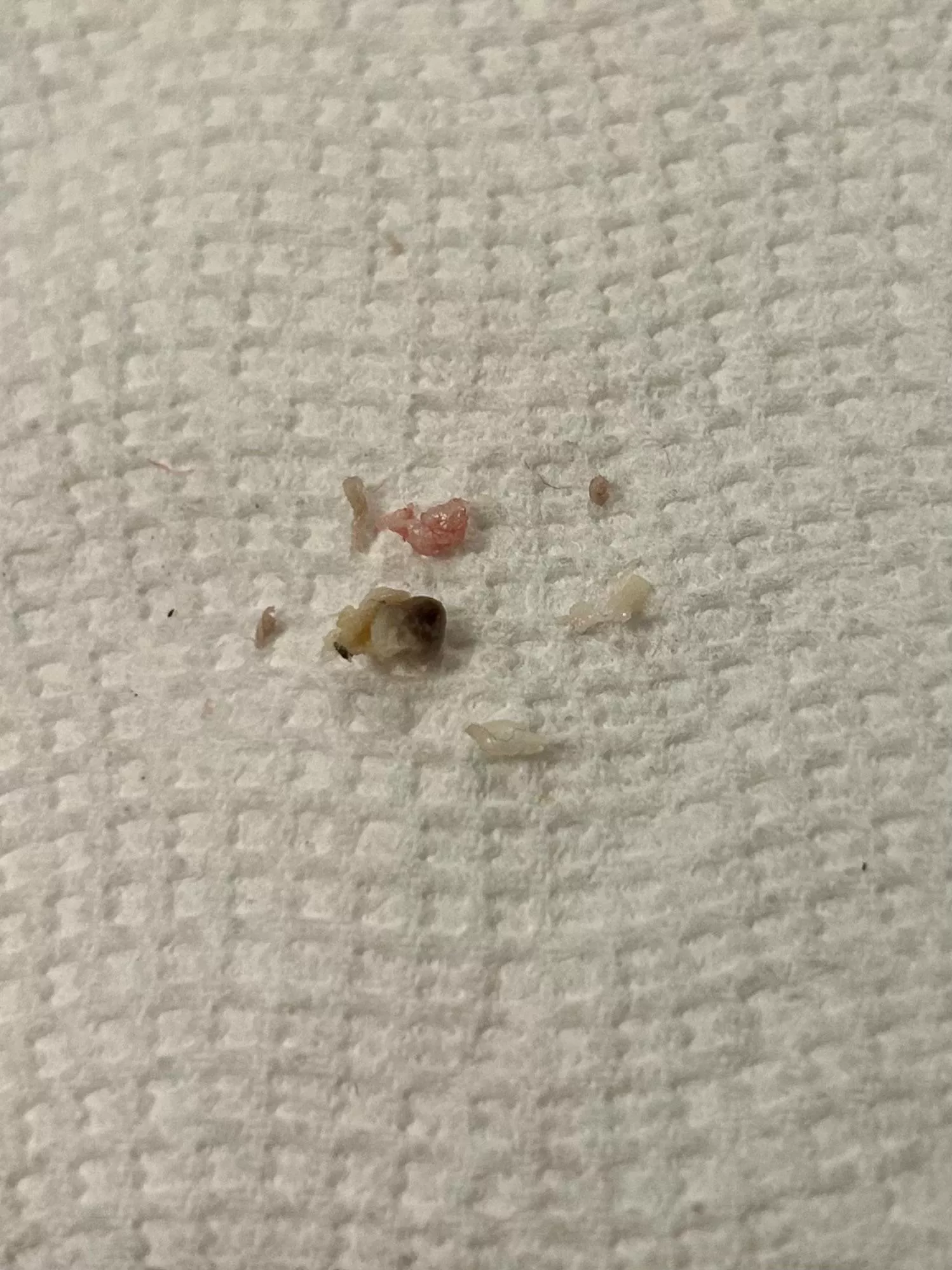 The grody results of what I thought was a regular pimple on my inner thigh from chafing! Wish I'd thought to record the very bloody cyst pop 🍾