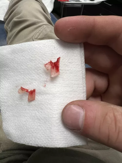 Ingrowns I had removed today