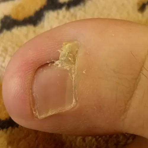 Finally popped this ingrown part of toenail out of my toe.