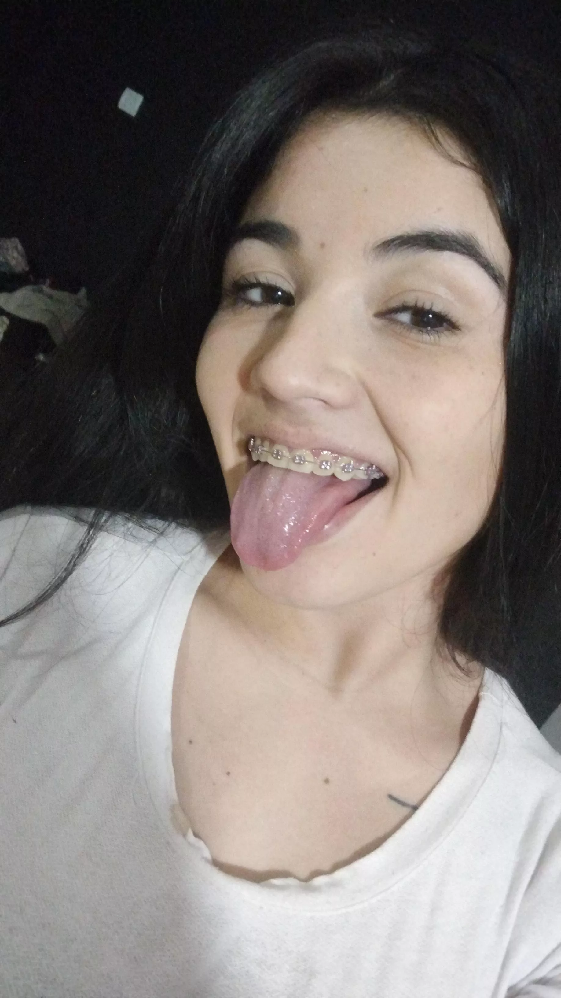 What do you think of my pink braces?