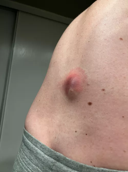 20-year old back cyst finally ruptured, a week before my surgery -_-