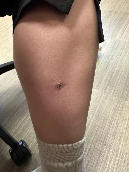 Cellulitis girl final update