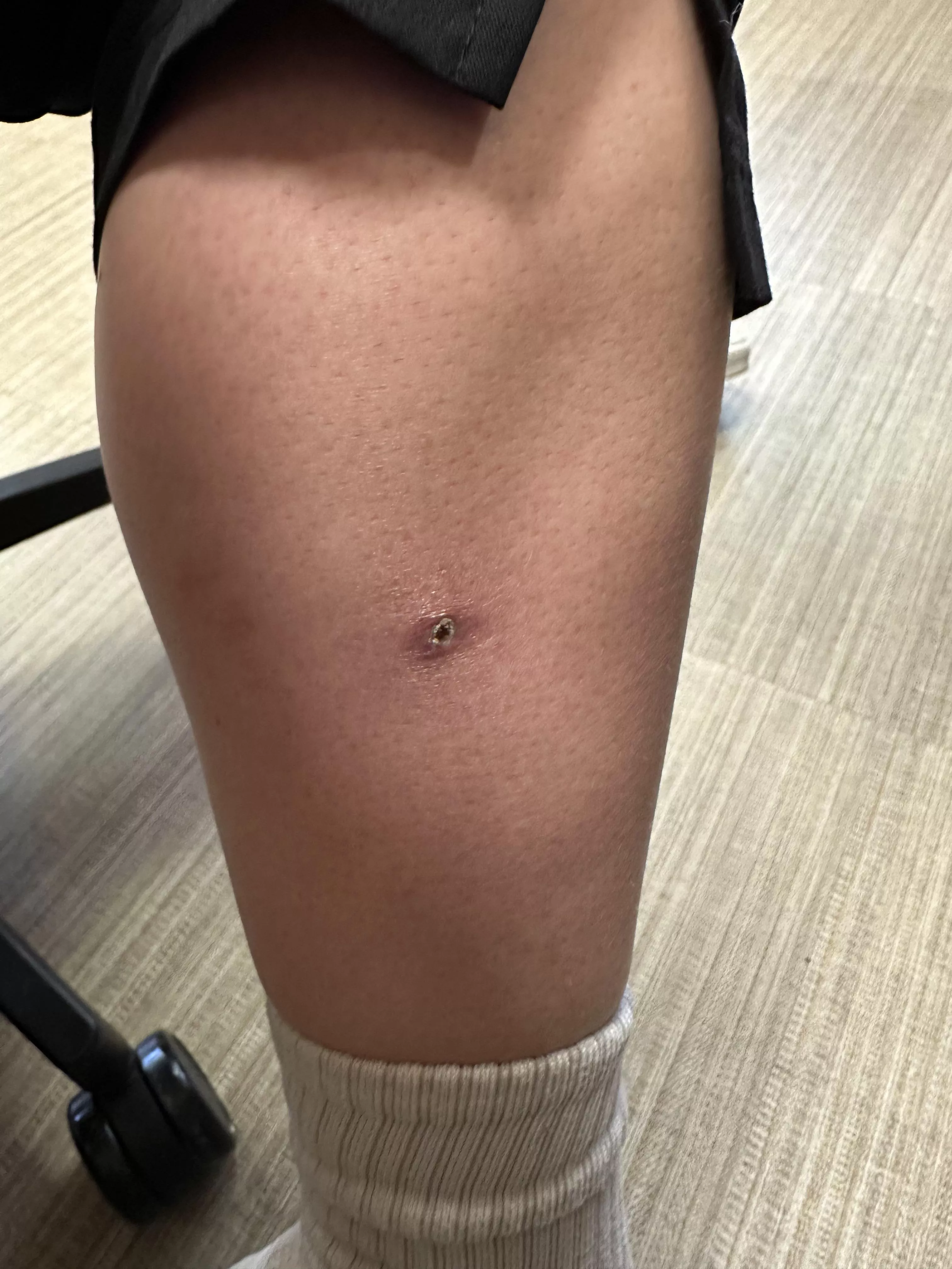 Cellulitis girl final update