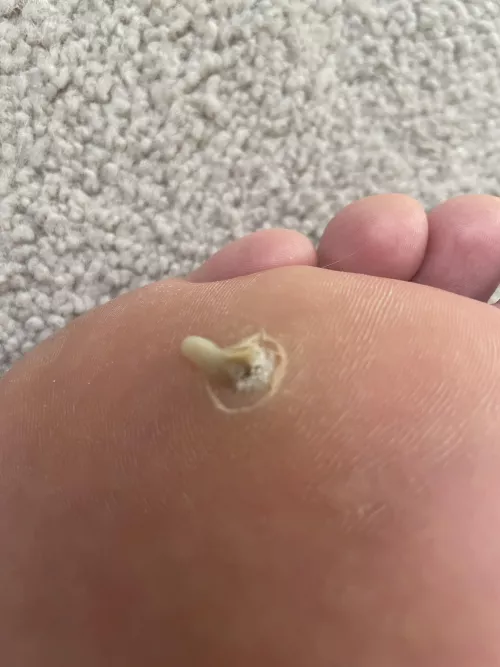 Found out why it hurt to walk on my foot after my plantar wart extraction