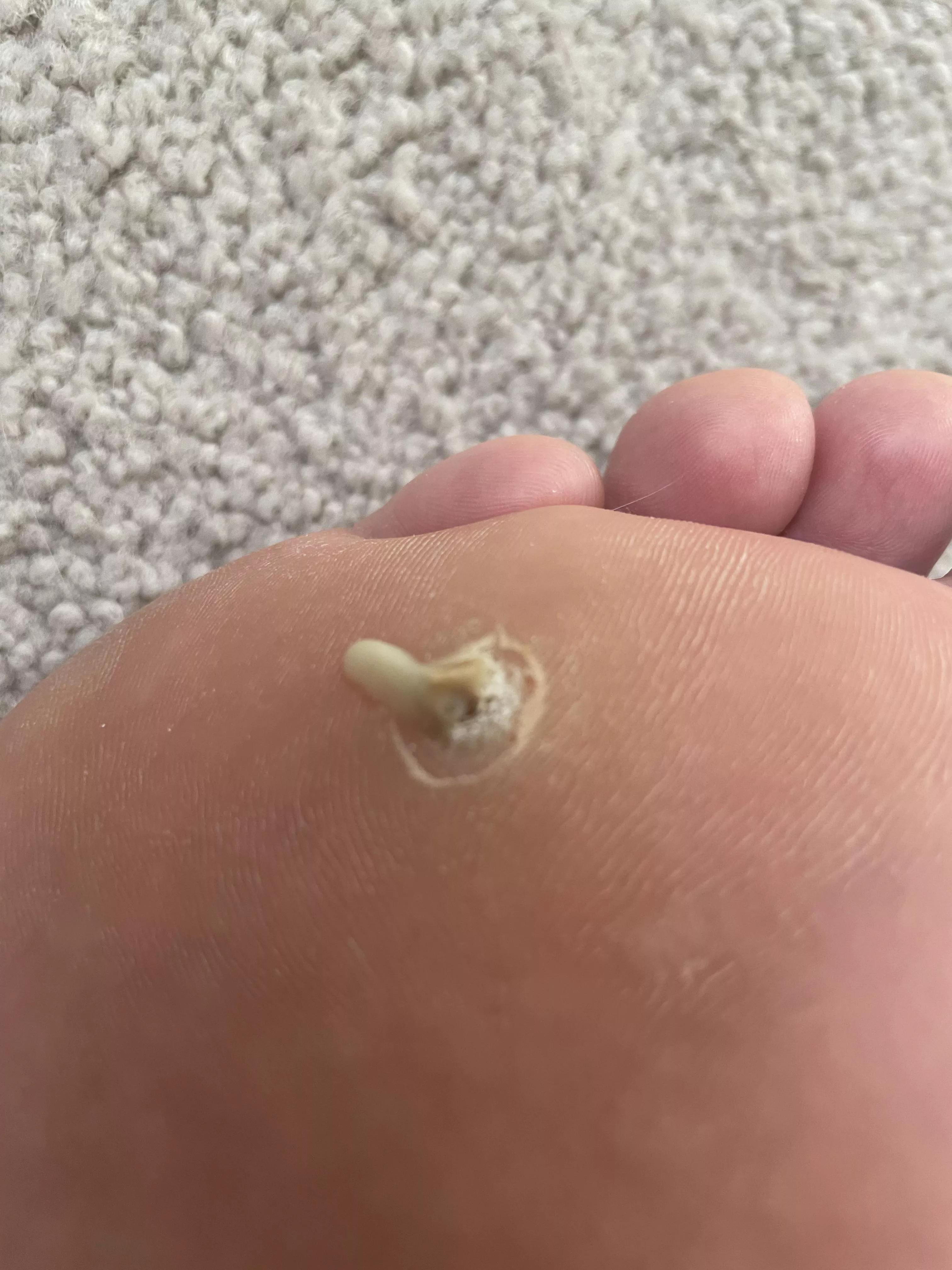 Found out why it hurt to walk on my foot after my plantar wart extraction