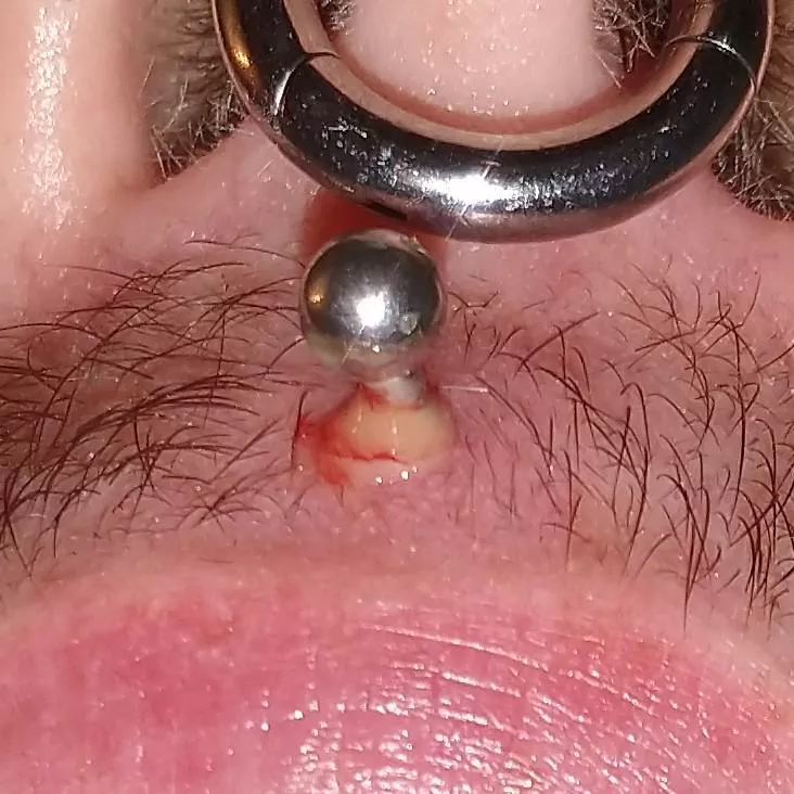 so.. my Medusa got infected