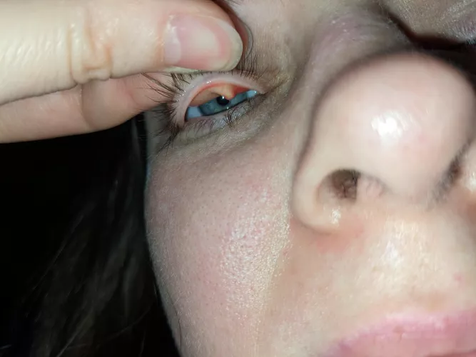 Got a chalazion - one of those forbidden pops