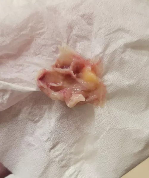 pretty sure this is a nasal polyp 