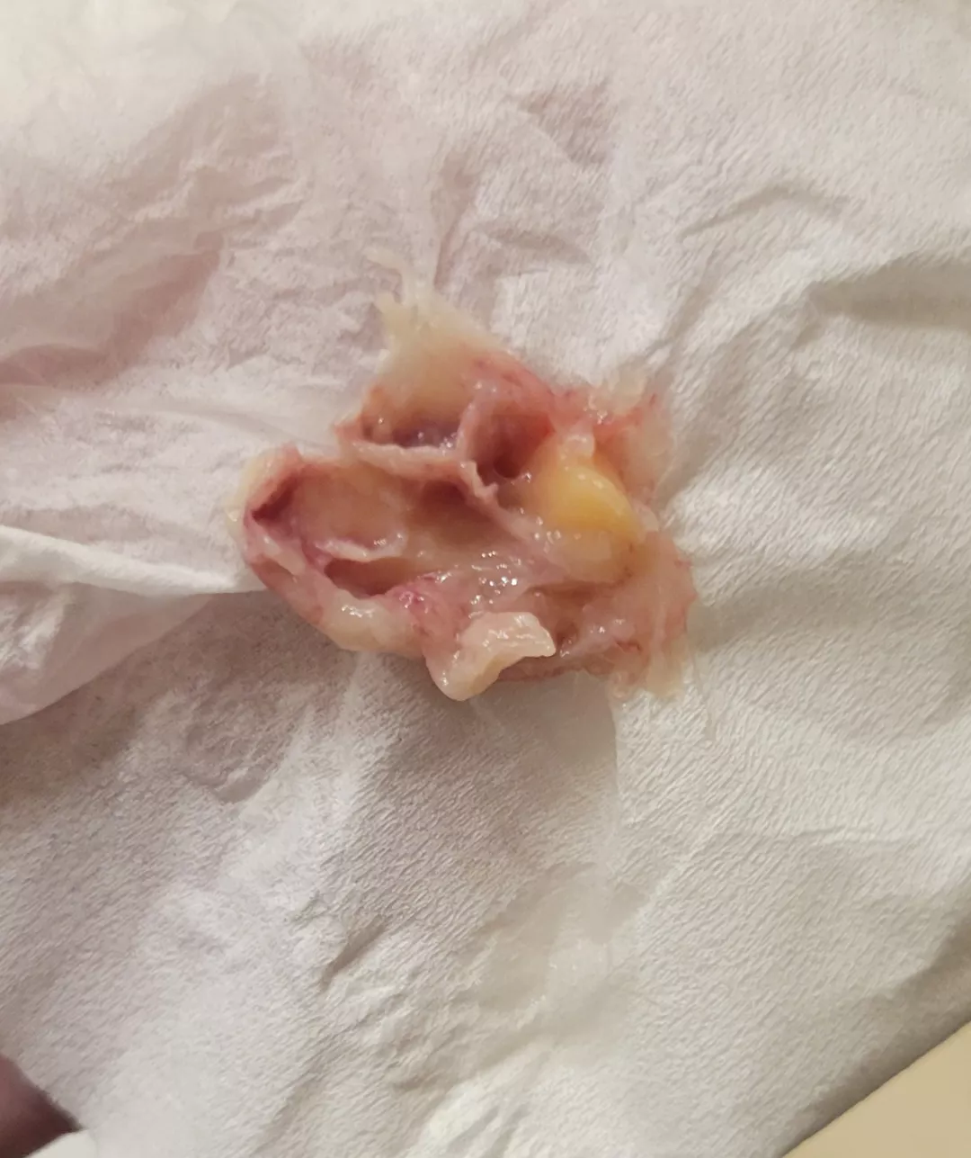 pretty sure this is a nasal polyp 