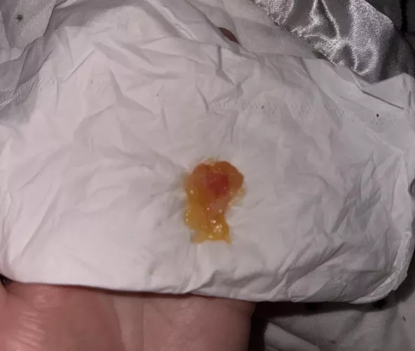 Sinus infection Booger 👀