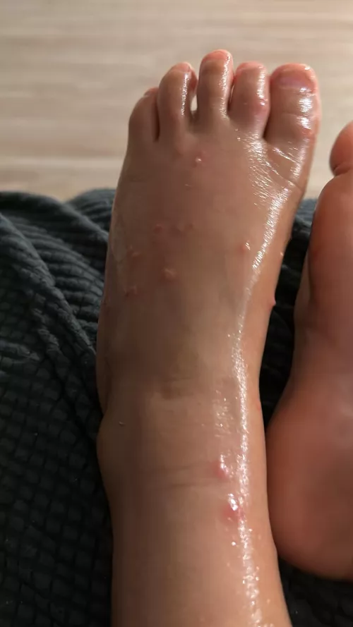 Toddler had a terrible experience after playing with a fire ant mound, counted 33 bites on one foot alone. 