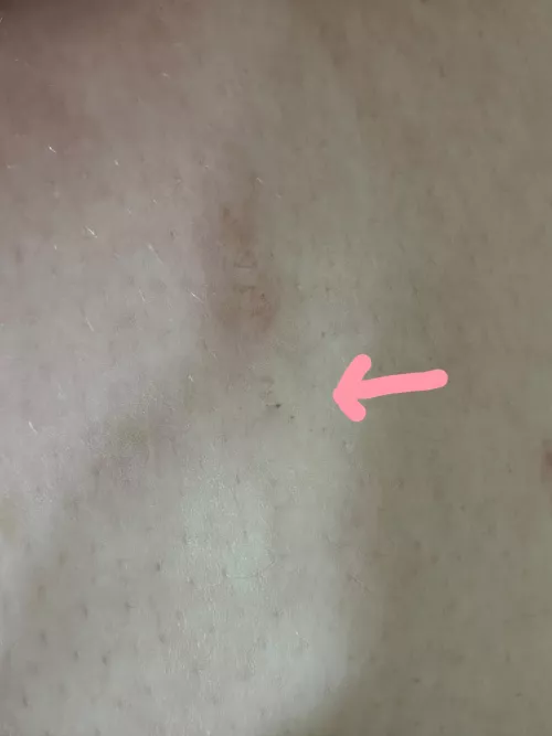 Blackhead in surgery scar won’t go away.