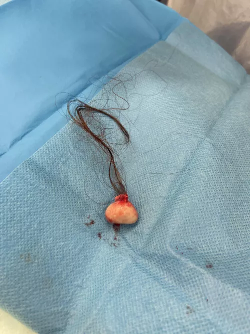 Pilar cyst removed from my head today!