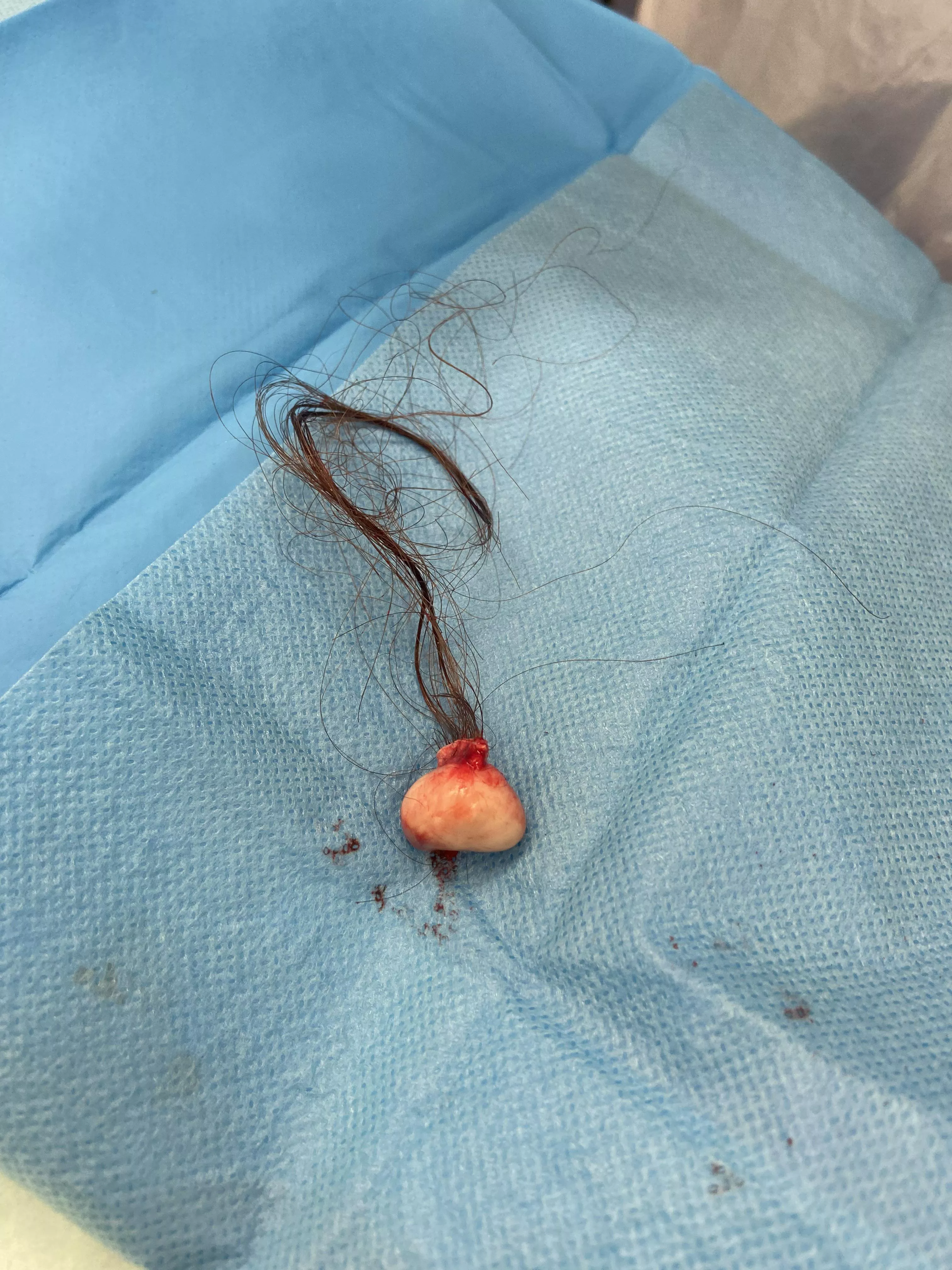Pilar cyst removed from my head today!