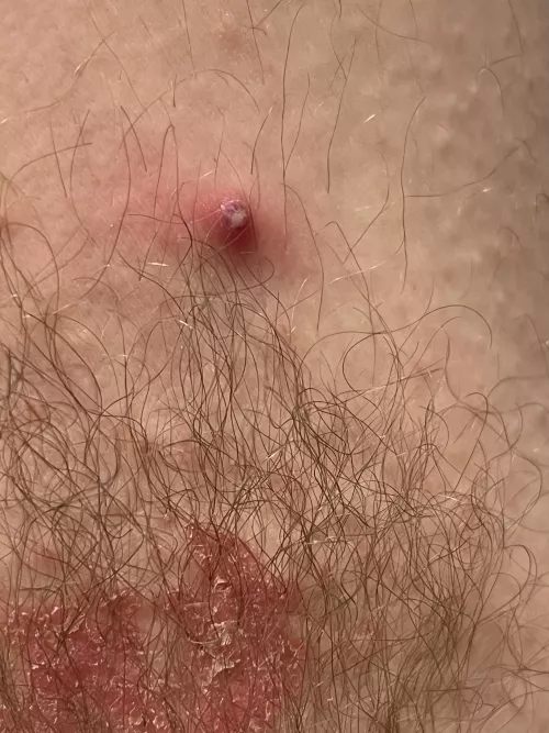 Armpit rash has lead to this beauty just waiting to pop