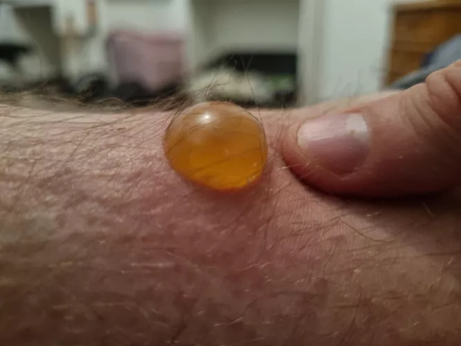 Blister on my foot from mosquito bite