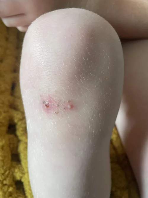 Forbidden pop on my kid’s knee