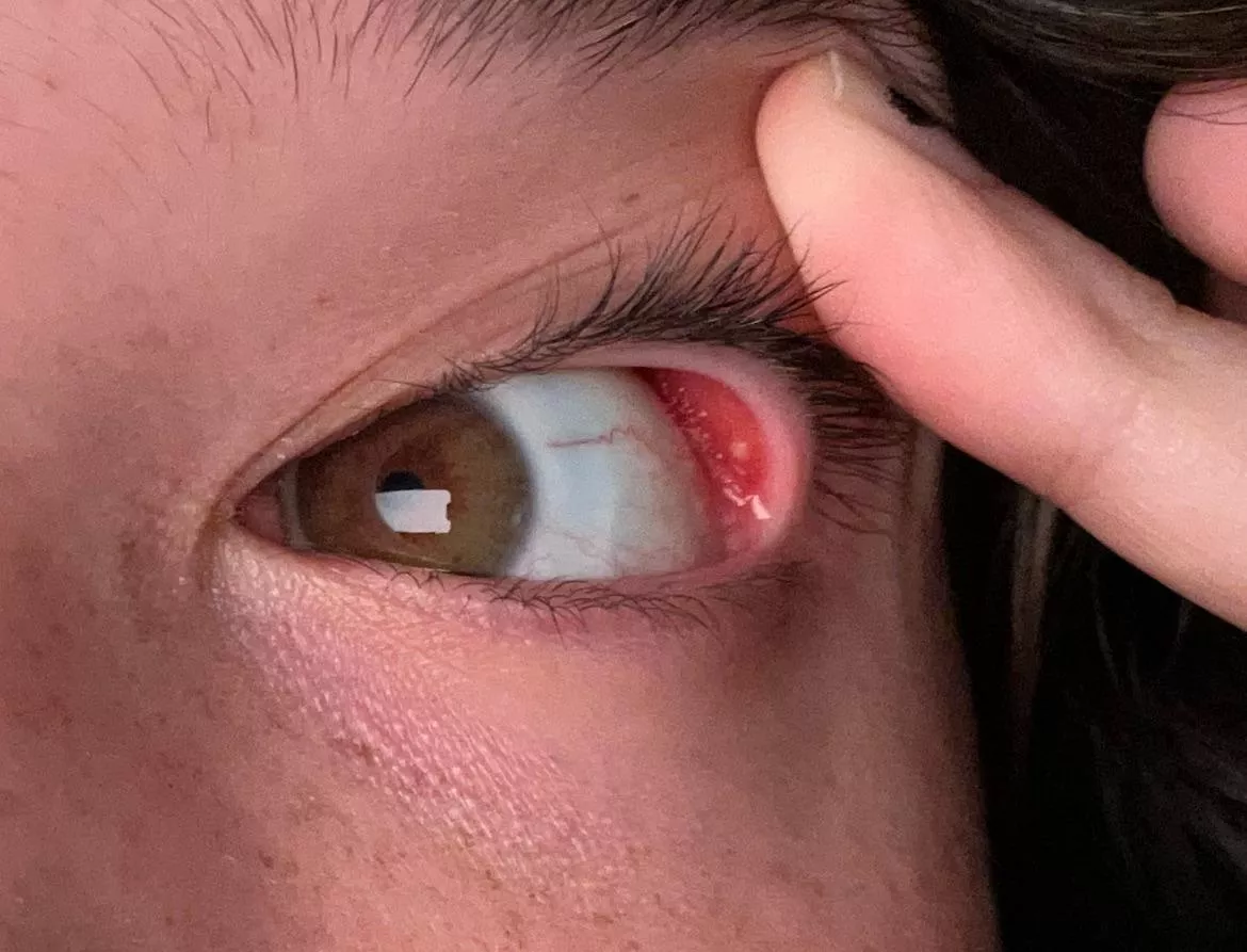 forbidden pop: pimple inside my eye?!