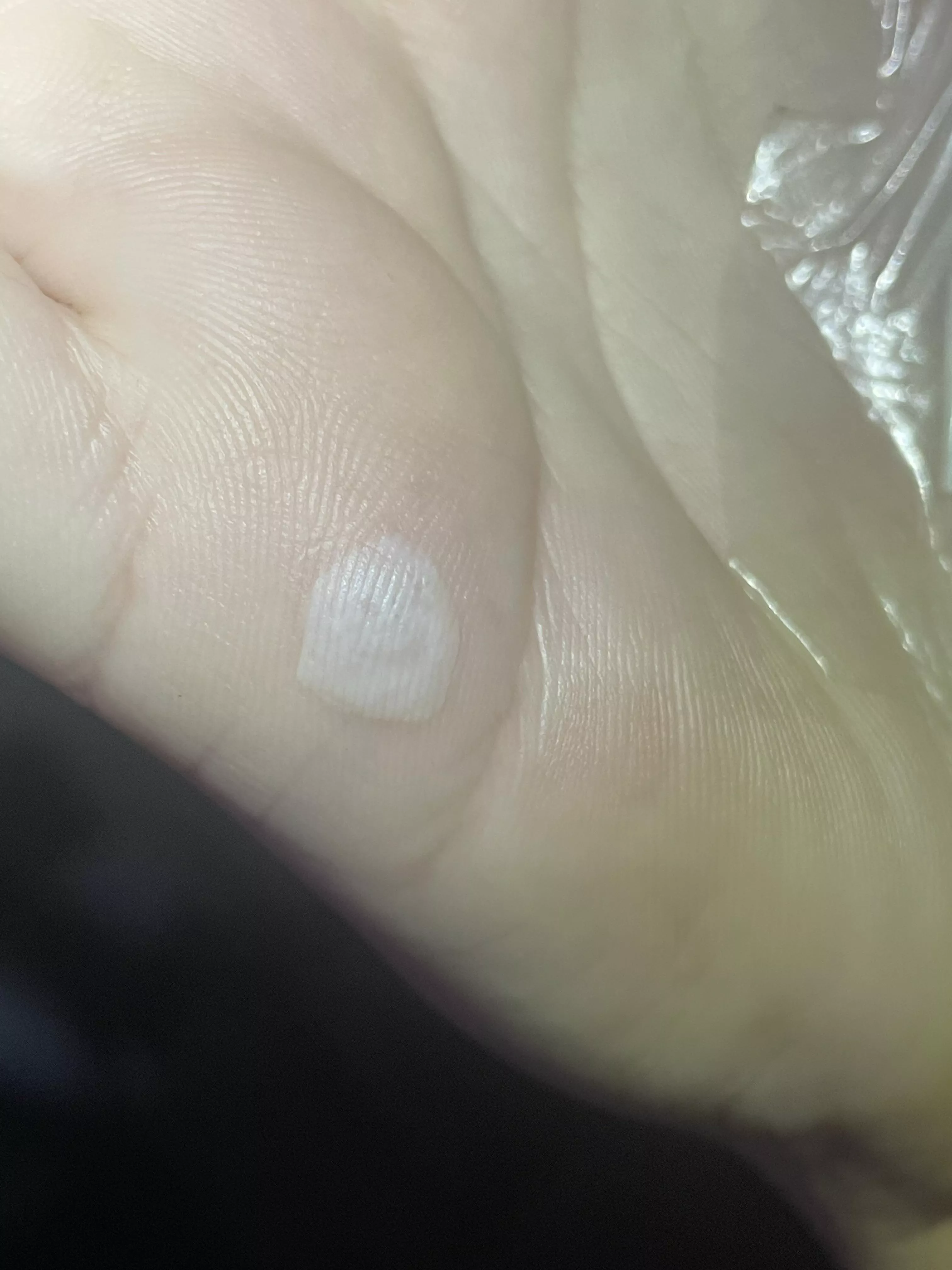 Hand blister…smiling?