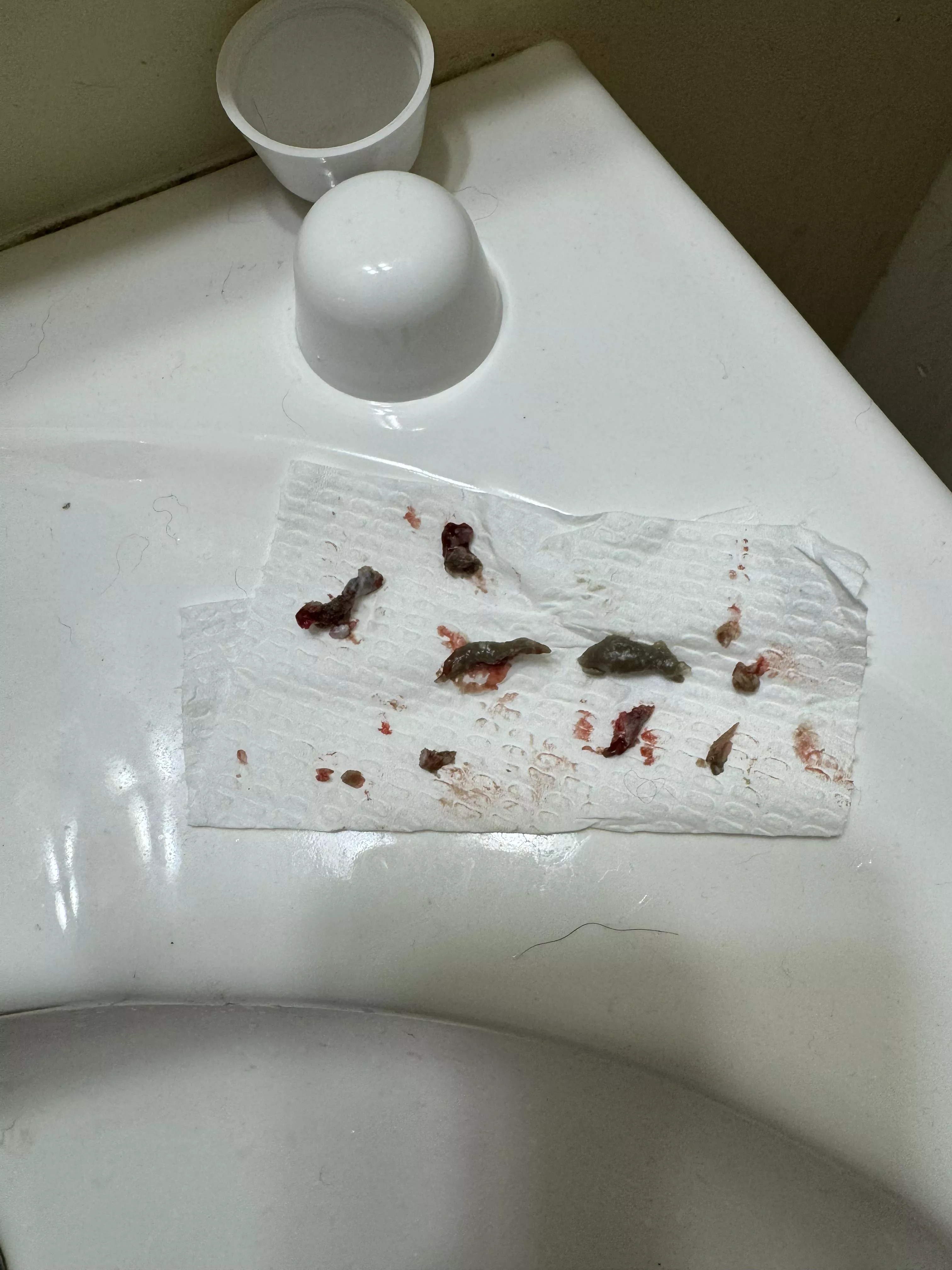 Aftermath of epidermoid cyst popping