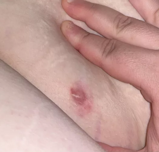 Boil in my waist? Hurts for sure