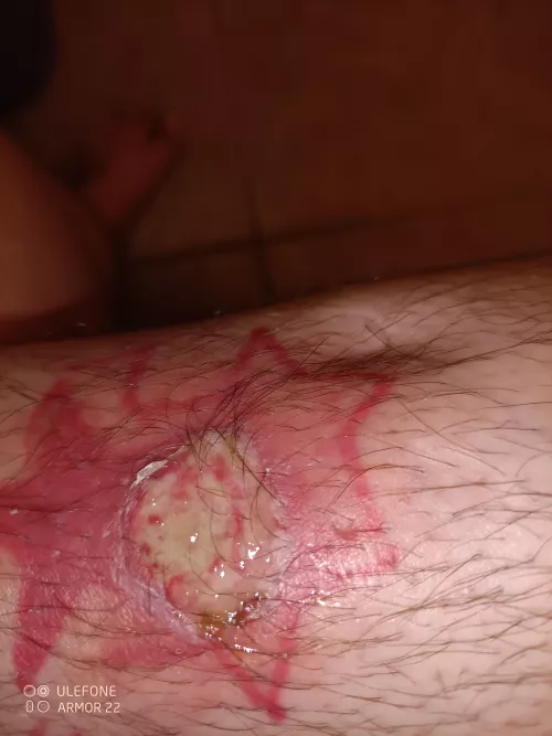 Rotting leg girl here, shit went bad. Almost about to excise this myself.